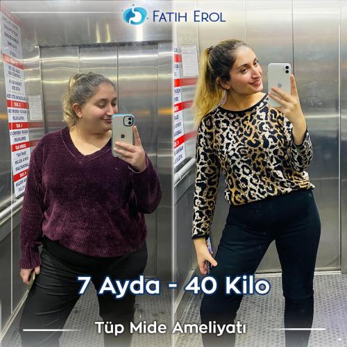 2022 10 00 fatih erol before after4