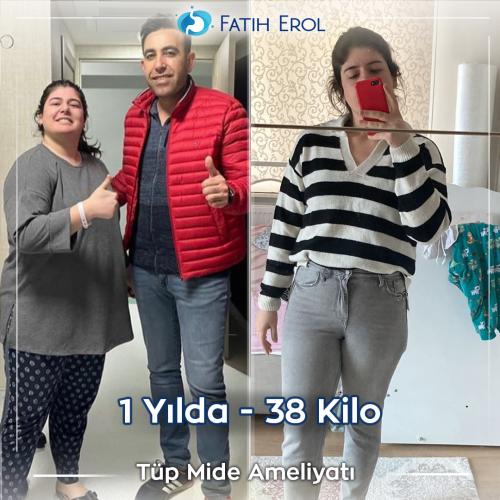 2022 11 00 fatih erol before after
